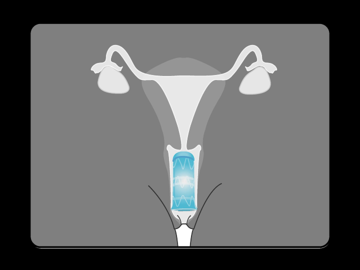 resizecom_device in place shrunk